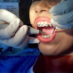 Aneka Tips: Membersihkan Karang Gigi Ternyata Mengerikan