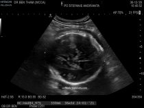 Pregnancy Journey: 10 Prenatal Visit (38 Minggu) – Bayi Mungil